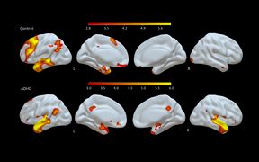 Brain activations in ADHD and controls